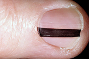 Черные черточки на ногтях