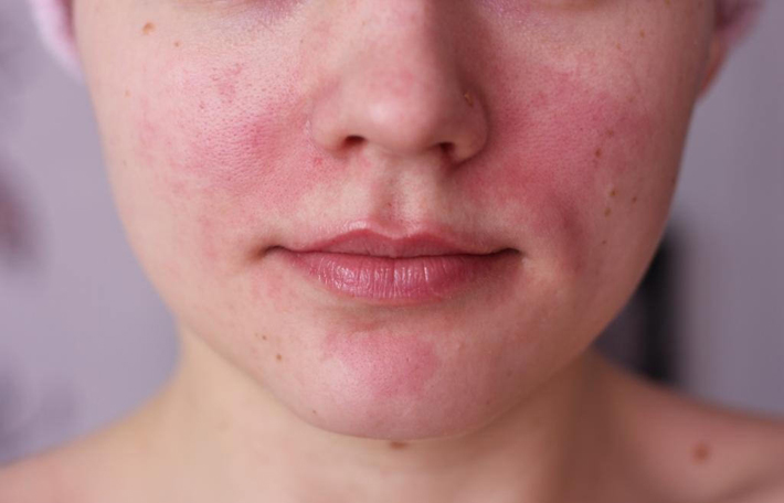 Шелушение и покраснение кожи на лице лечение 44