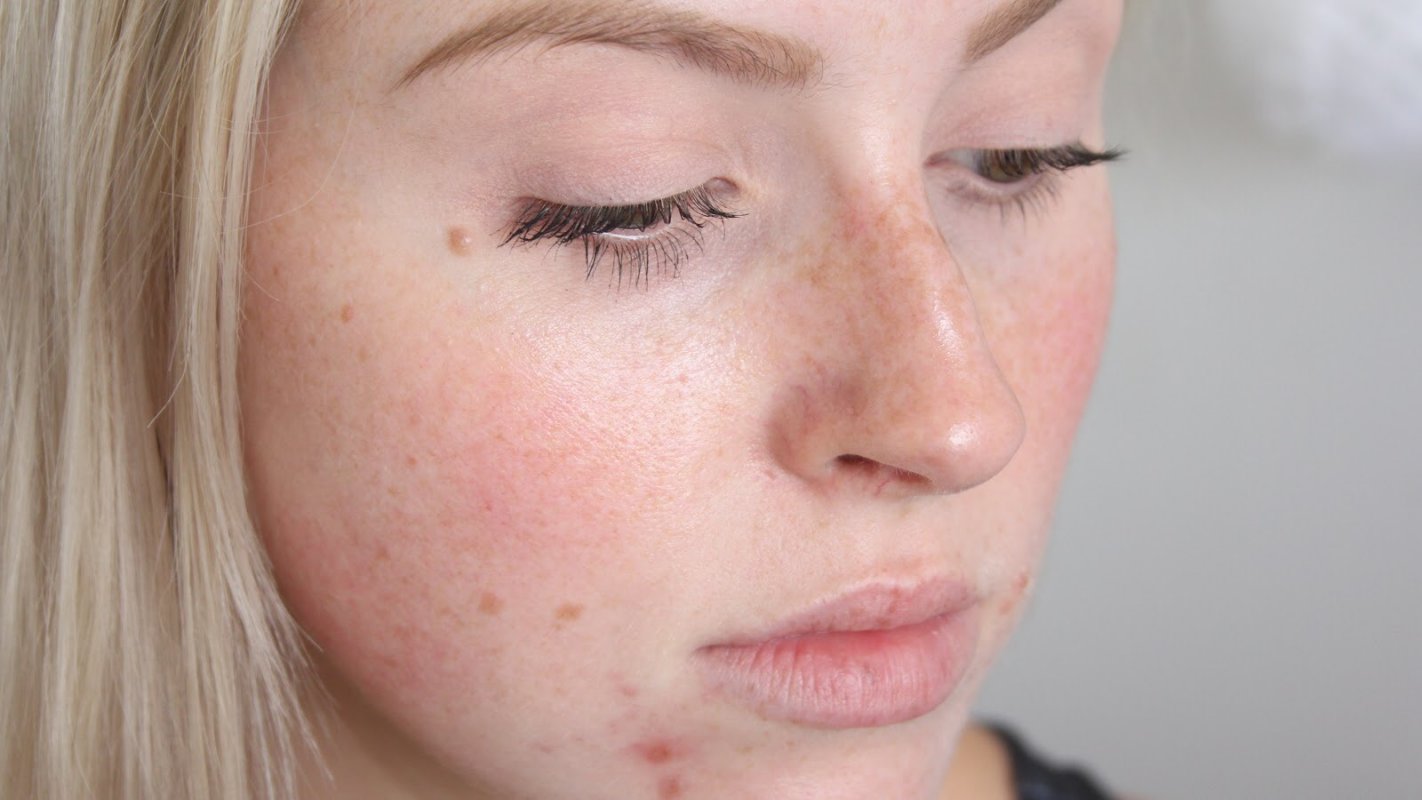 Шелушение и покраснение кожи на лице лечение 47