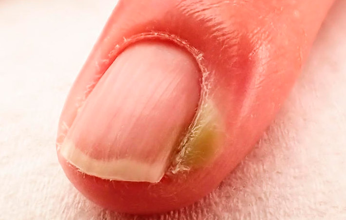 Как называется болезнь когда грызут ногти