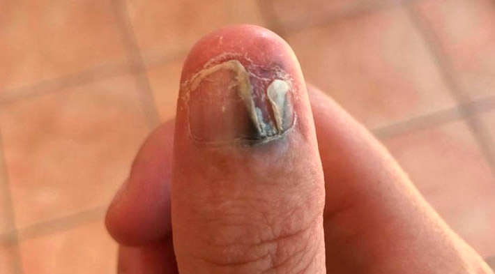 Как называется болезнь когда грызут ногти