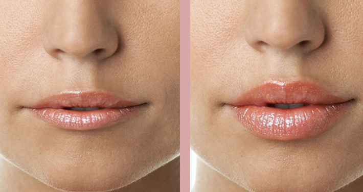 До и после увеличения губ