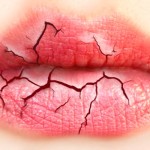 Чем лечить трещины на губах (14 способов)