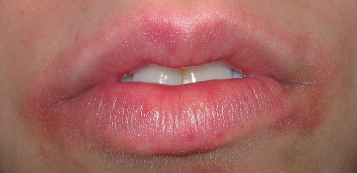 Аллергия для губ