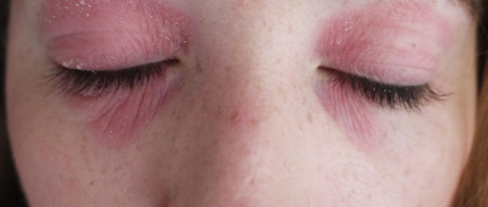 Аллергия на тушь на одном глазу thumbnail